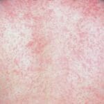 Potential measles exposure at URVH, Fredericton airport